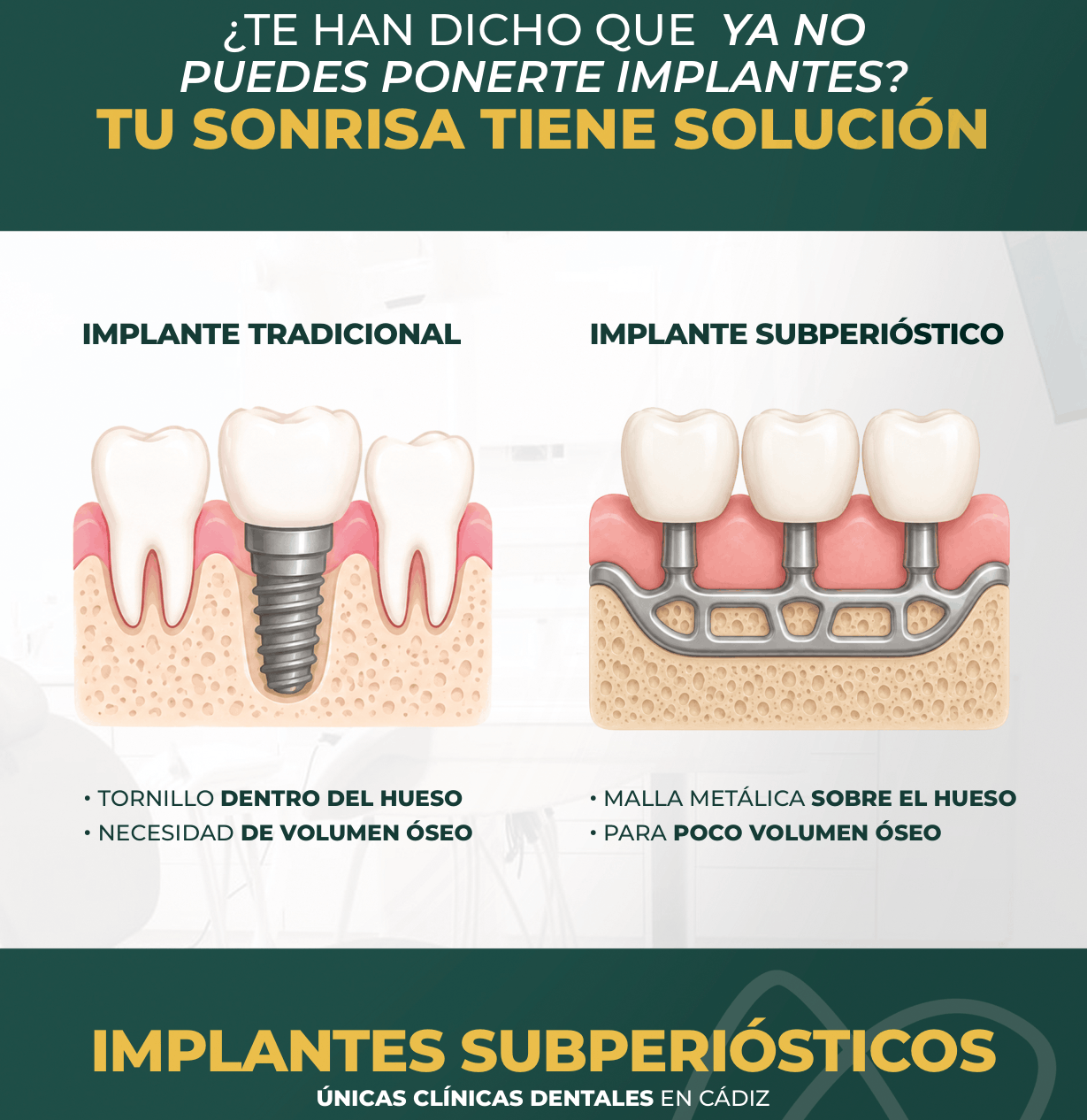 Implantes Subperiósticos en El Puerto de Santa María​ | Implantes Subperiósticos en Sanlúcar de Barrameda